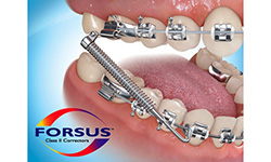 lingual braces